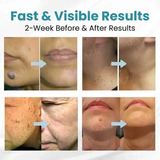 [⚡️BEST DEAL TODAY]🔥Non-Invasive Mole and Wart Removal Laser Pen