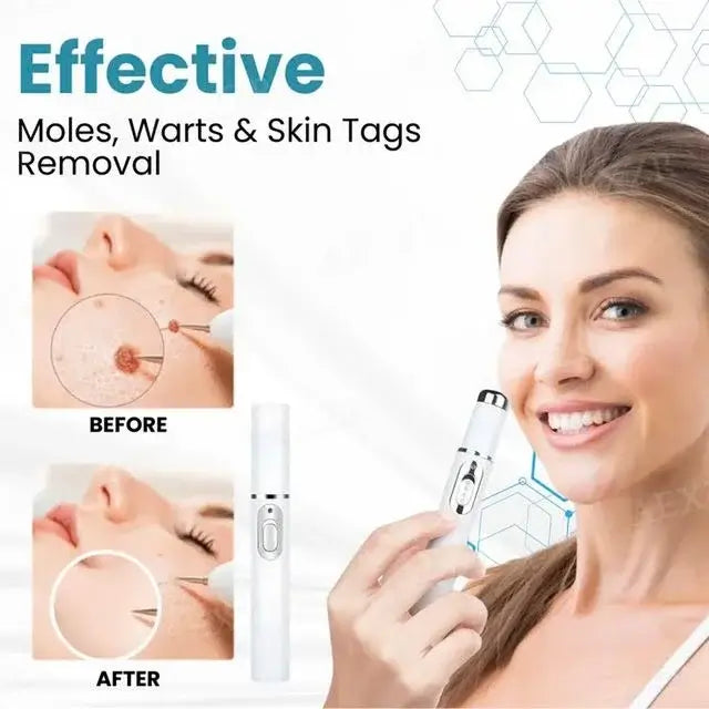 [⚡️BEST DEAL TODAY]🔥Non-Invasive Mole and Wart Removal Laser Pen